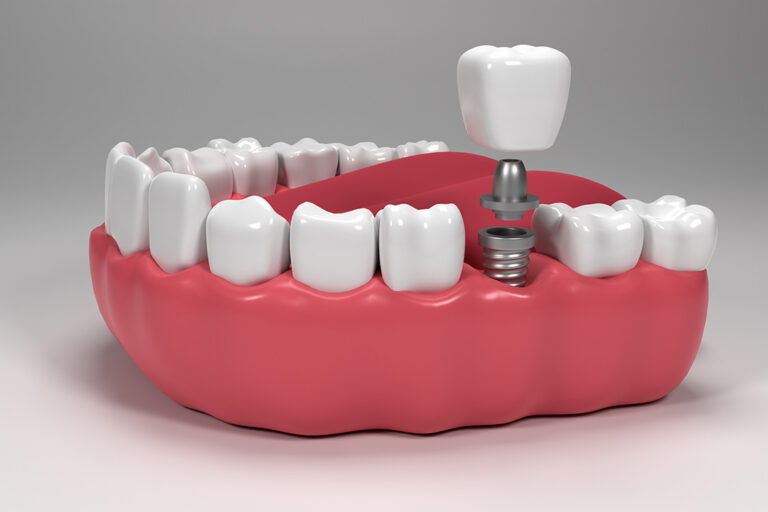 All Kinds of Implants