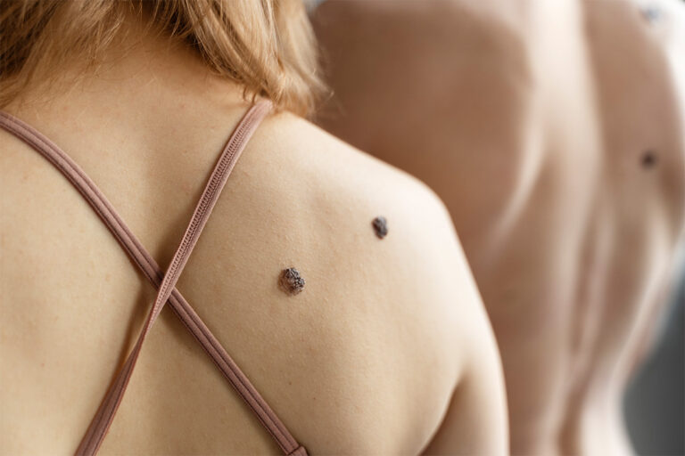 Moles & Warts Removal