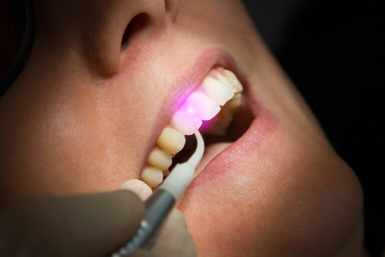 RCT by Laser
